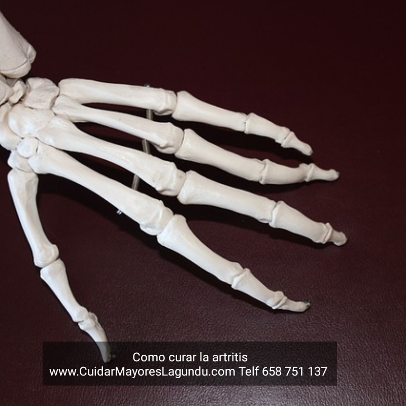 Como Curar la Artritis